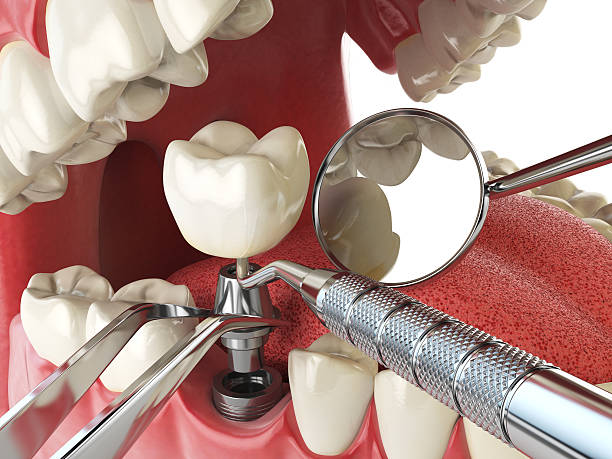 Best Emergency Dental Care for Broken or Chipped Teeth in Brookhaven, WV